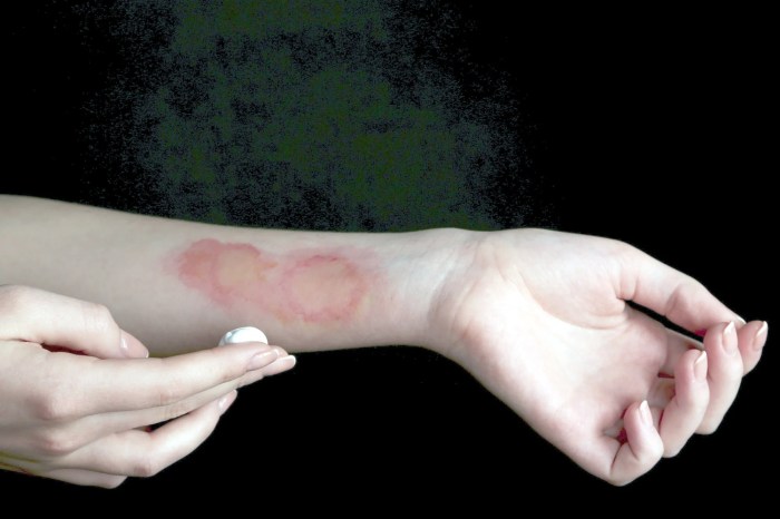 Chemical Burn at Work – A Guide to Claiming Compensation